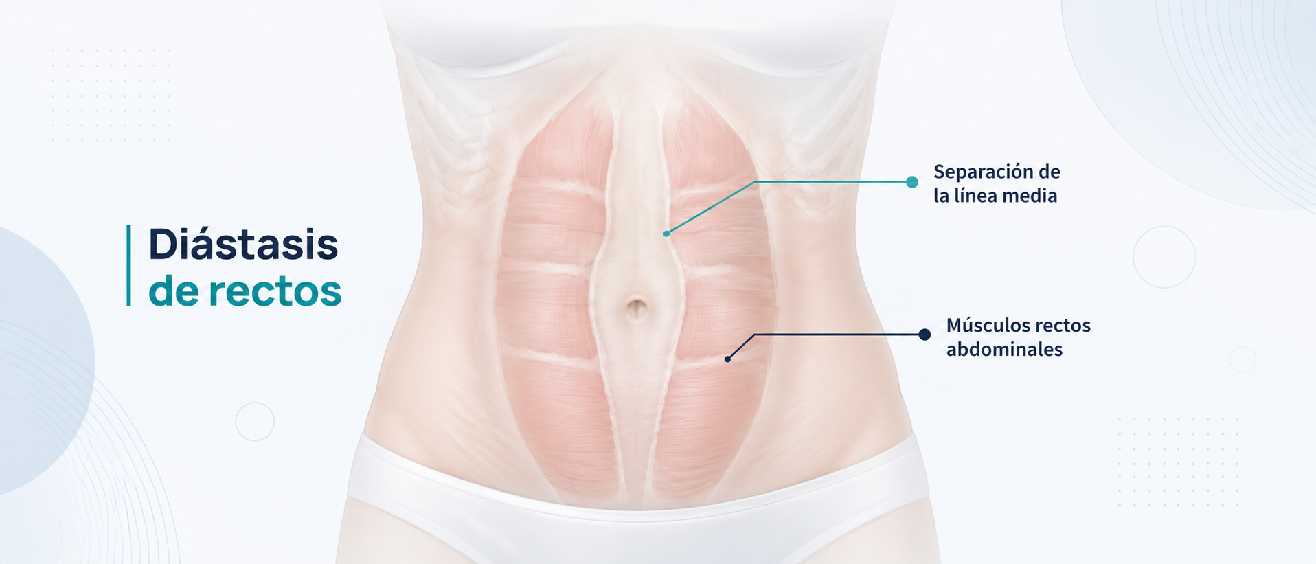 Diagrama médico de la línea media abdominal que muestra la separación de los músculos rectos en una diástasis
