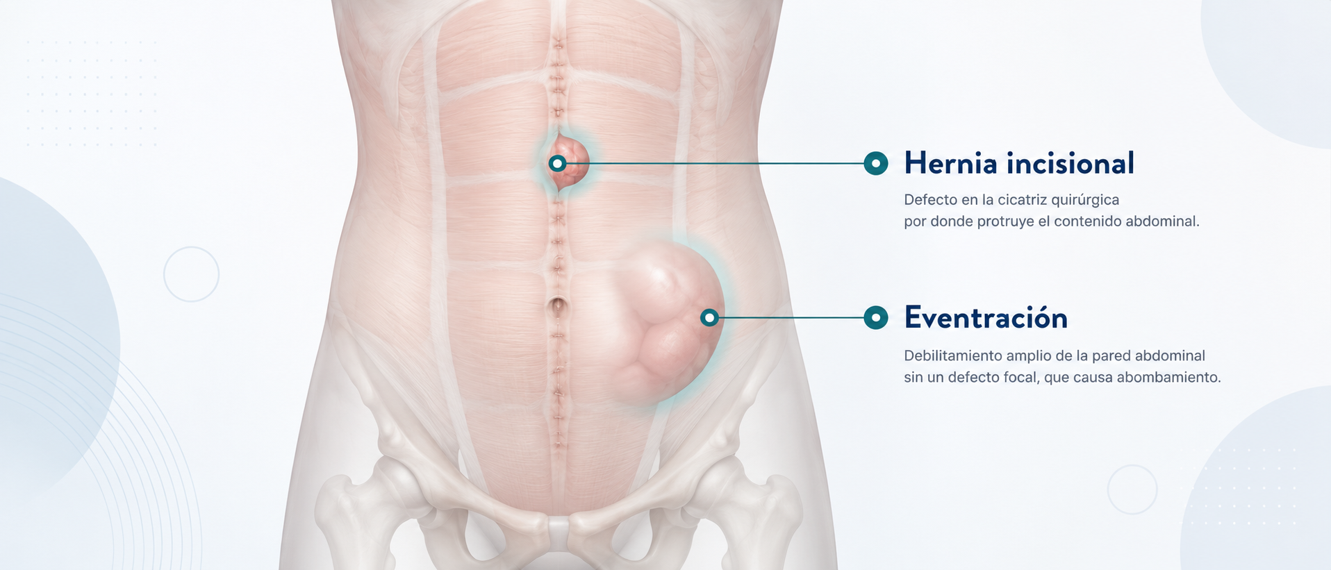 Diagrama médico de la pared abdominal que muestra una hernia incisional sobre una cicatriz quirúrgica y una eventración