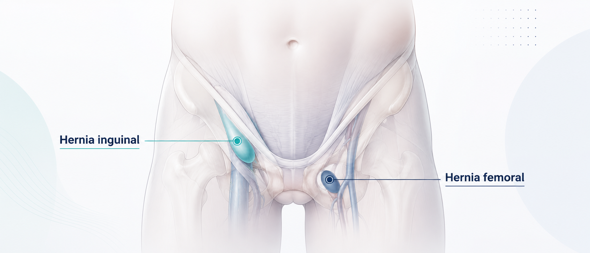 Diagrama médico de la región de la ingle que señala una hernia inguinal y una hernia femoral