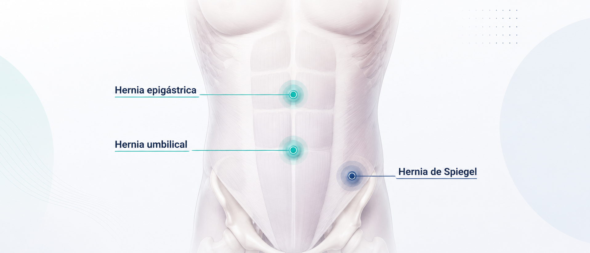 Diagrama médico de la pared abdominal que señala una hernia epigástrica, una hernia umbilical y una hernia de Spiegel