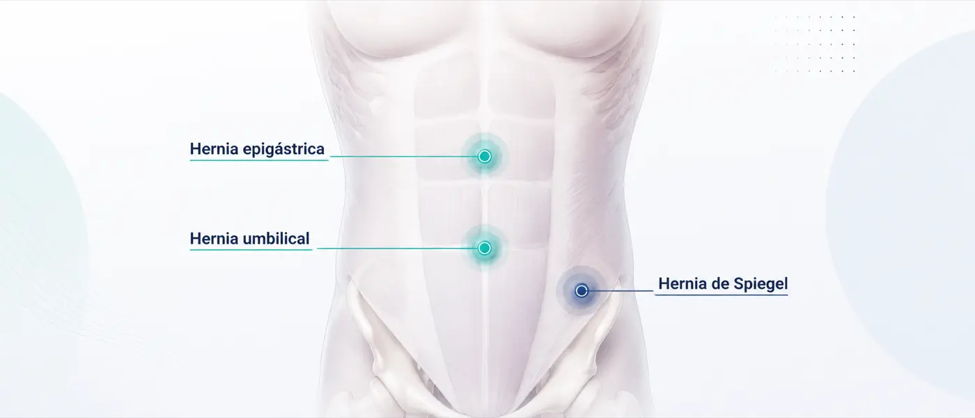 Ilustración de hernias umbilical, epigástrica y otras hernias ventrales